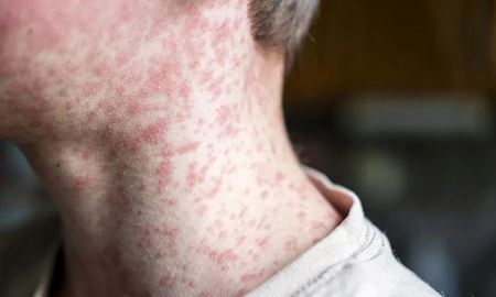 هشدار فوری بهداشتی در سیدنی به‌دنبال شناسایی یک مورد جدید ابتلا به سرخک