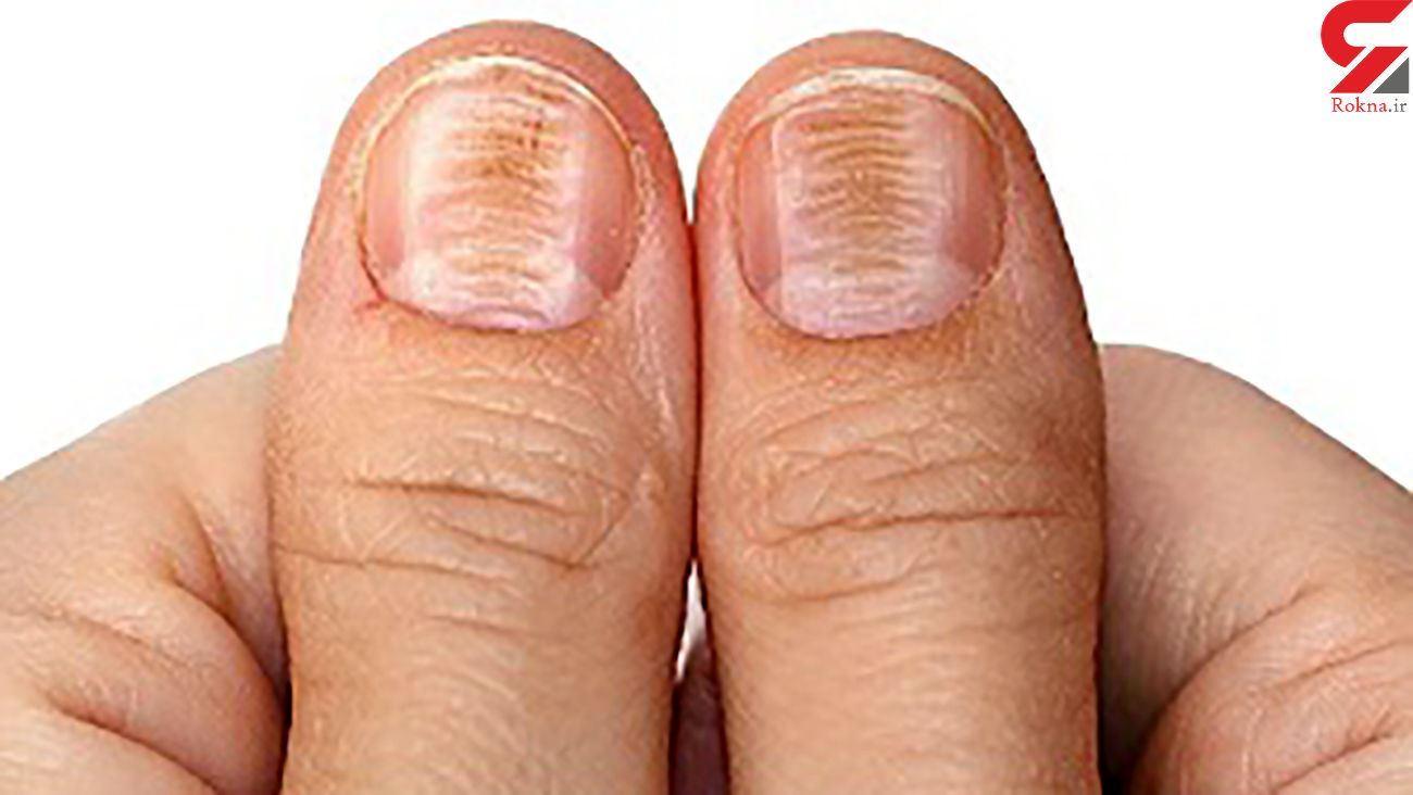 ضرورت بررسی وضعیت ناخن‌ها برای تشخیص زودهنگام سرطان پوست
