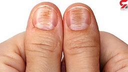 ضرورت بررسی وضعیت ناخن‌ها برای تشخیص زودهنگام سرطان پوست