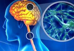 برای نخستین بار عامل بیماری ام‌اس شناسایی شد