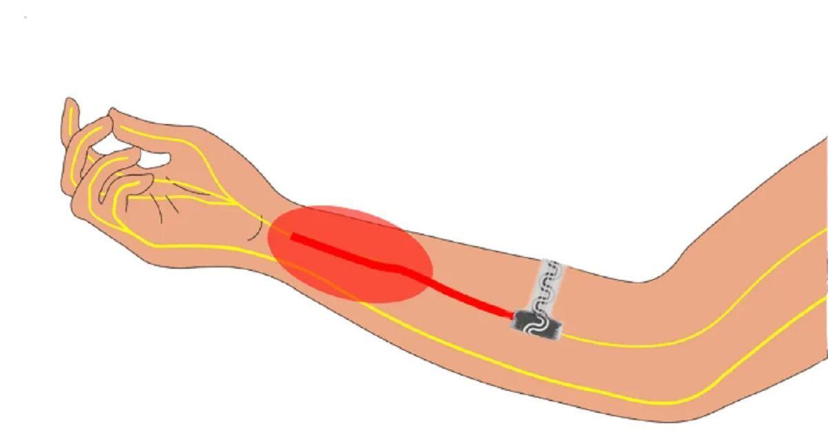 تسکین درد بدون نیاز به مواد مخدر و با یک نوار باریک