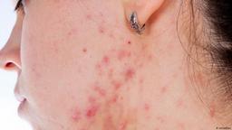 رابطه معکوس مصرف امگا۳ با جوش‌های صورت