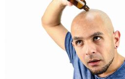 درمان طاسی مردان ممکن می‌شود؟