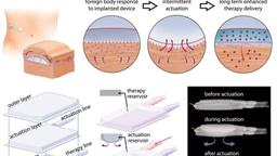 ساخت پانکراس مصنوعی برای کمک به بیماران دیابتی