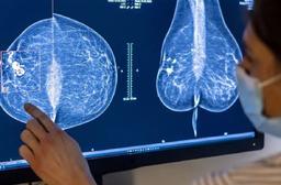 توسعه ابزارهایی برای تشخیص زودهنگام سرطان سینه با هوش مصنوعی گوگل