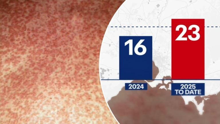 افزایش نگران‌کننده شیوع سرخک در ویکتوریا؛ مقامات بهداشتی هشدار دادند