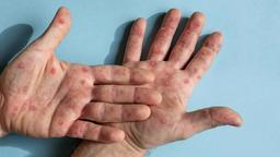 هشدار شیوع محلی ویروس آبله میمون در پایتخت ایالت ویکتوریا