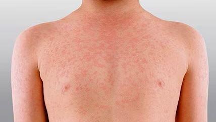 افزایش بی‌سابقه شیوع سرخک در استرالیای غربی؛ بالاترین میزان ابتلا در سه دهه اخیر