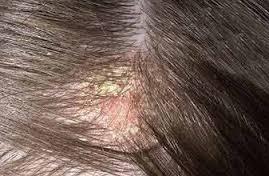 شوره سر را بهتر بشناسیم