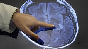 بازسازی سلول های مغز انسان محقق شد