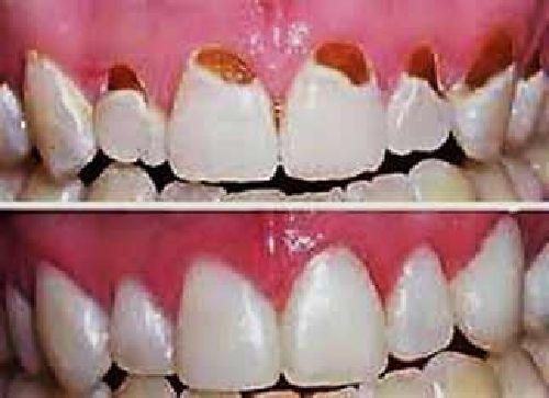 موضوع دندانپزشکی: درمان های ترمیمی "اینله" و "اوونله" و پاسخ به سوالات