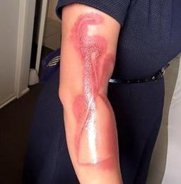 آیا گوشی آیفن 7 باعث جراحت سوختگی "ملانی استرالیایی" شد؟