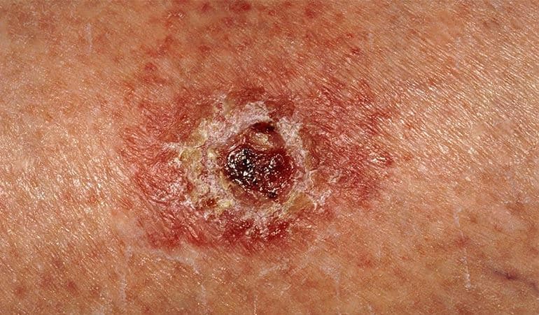 ابداع روش جدید برای تشخیص شایع‌ترین نوع سرطان پوست (ملانوم)