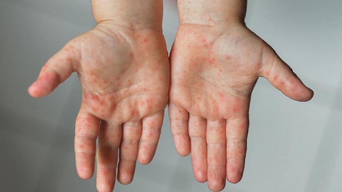 افزایش ۸۰ درصدی ابتلا به سرخک در سراسر جهان