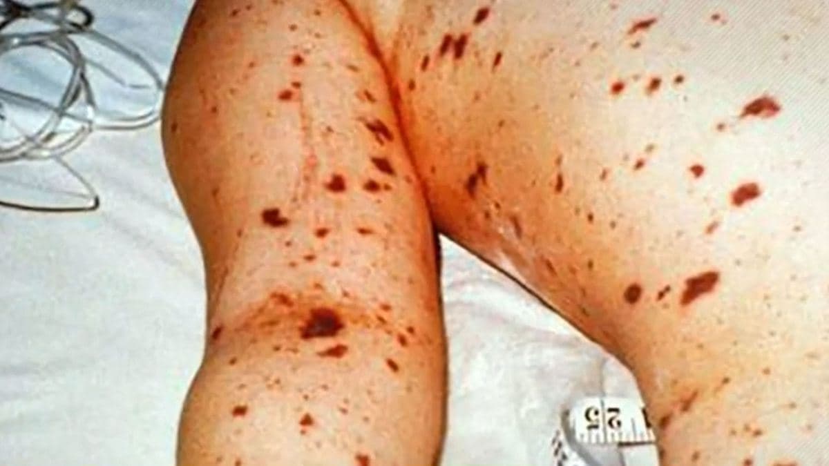 هشدار در خصوص شیوع باکتری «مننگوکوک ‌بی» در استرالیا