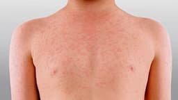 افزایش بی‌سابقه شیوع سرخک در استرالیای غربی؛ بالاترین میزان ابتلا در سه دهه اخیر