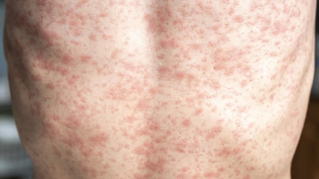 هشدار خطر ابتلا به سرخک در ایام کریسمس در سیدنی