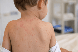 افزایش موارد سرخک در استرالیا؛ هشدار درباره شکاف ایمنی