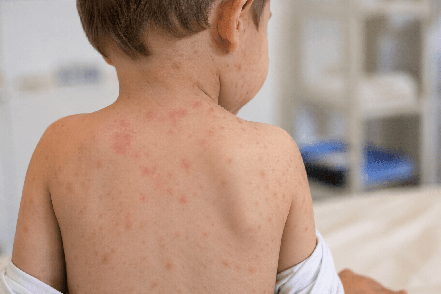 افزایش موارد سرخک در استرالیا؛ هشدار درباره شکاف ایمنی