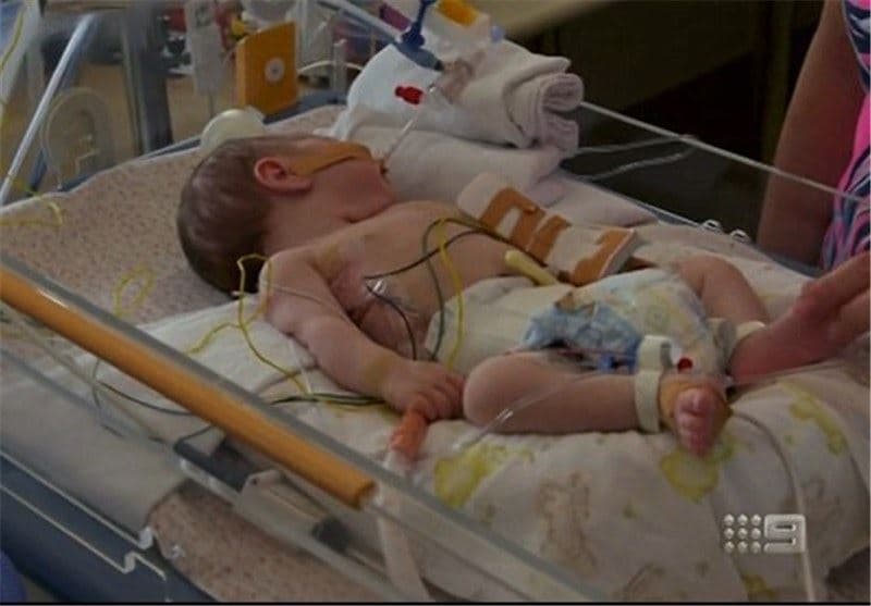 نجات معجزه‌آسای نوزاد ۱۳روزه پس از خارج کردن توده بزرگ در استرالیا