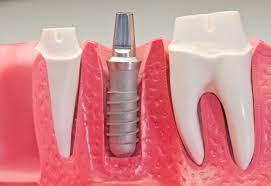 موضوع دندانپزشکی: ایمپلنت و  All on four ...همراه با دکتر مهرداد ابولقاسمی