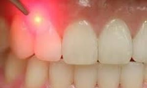 موضوع دندانپزشکی: کاربرد لیزر در دندانپزشکی و پاسخ به سوالات