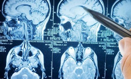 کشف جدید دانشمندان اسرائيلی در مورد سرطان مغز