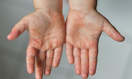 افزایش ۸۰ درصدی ابتلا به سرخک در سراسر جهان
