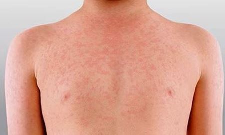 افزایش بی‌سابقه شیوع سرخک در استرالیای غربی؛ بالاترین میزان ابتلا در سه دهه اخیر