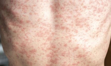 هشدار خطر ابتلا به سرخک در ایام کریسمس در سیدنی