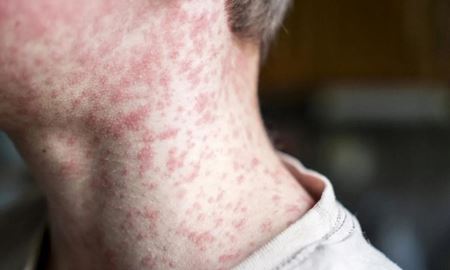 شناسایی موارد جدید سرخک در ایالت‌های نیوساوت‌ولز و استرالیای‌غربی